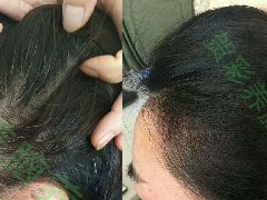 【贺彩讲堂】21岁女大学生，5年少年白发，28天白