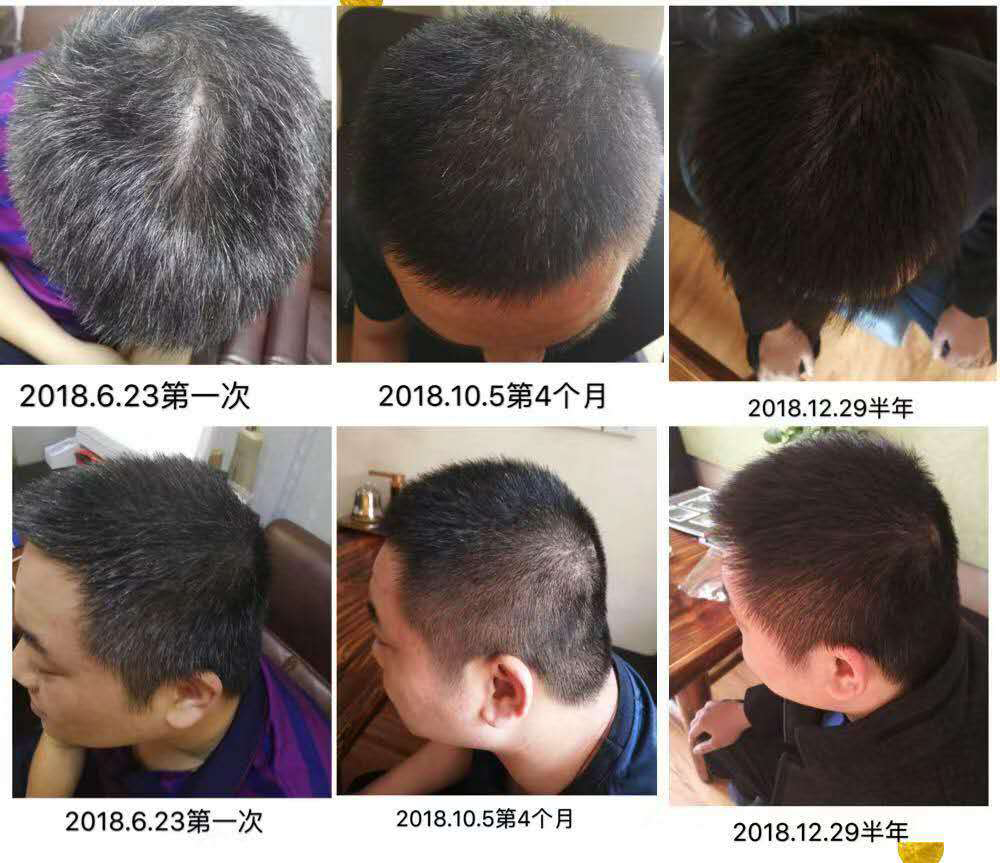 【贺彩推荐】告别白发，成功白发转黑发!
