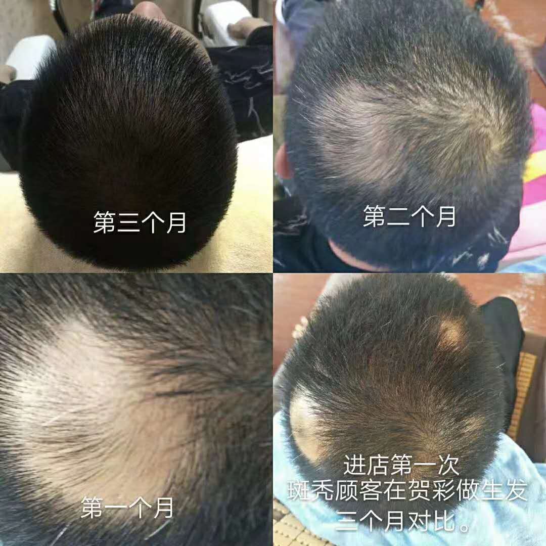【贺彩客户鉴证】90天奇迹生发！听一谢顶男人